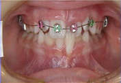 Crossbite with braces